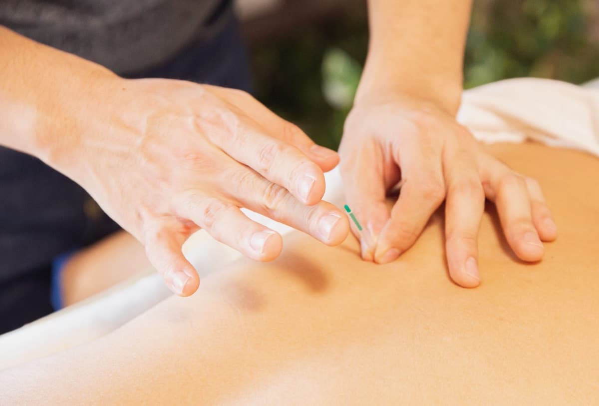A practitioner placing an acupuncture needle on a patient's back